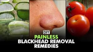 home remes to remove blackheads