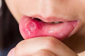 what causes canker sores how can you