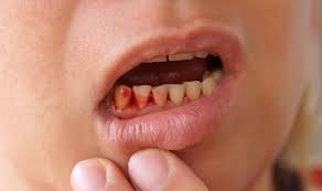 Thus, when faced with an overbite, you should consult a dentist. Quiz Why Do Your Gums Bleed