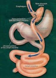 gastric byp surgery the benefits
