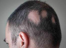 Alopecia Areata: Overview and more