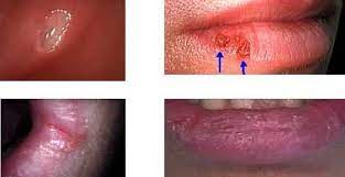 photos of chapped lips herpes canker sores