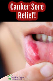 how to stop canker sores forever