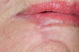 excised skin cancer of the lip stock