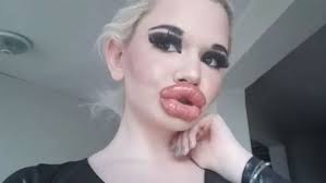 giant lips after 20th filler injection