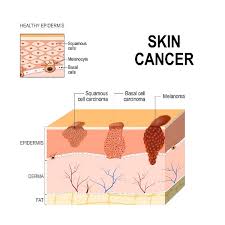 skin cancer symptoms treatments