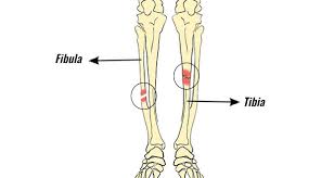 lower leg fractures