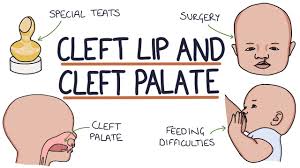 cleft lip and cleft palate for