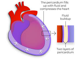 Pericarditis is usually mild and goes away without treatment. Recurrent Pericarditis Management Treatment