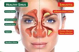 sinusitis types and causes symptoms