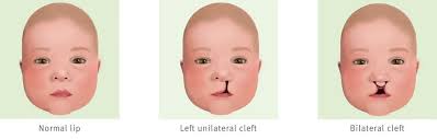cleft lip children s health queensland