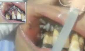 Wriggling maggots in a patient's mouth in Brazil | Daily Mail Online