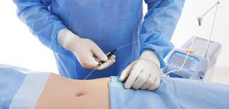 laser liposuction smartlipo is it