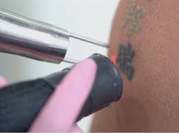 laser tattoo removal in long island