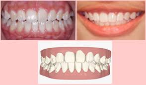 The Size And Shape Of Your Teeth Manhattan Bridge Orthodontics