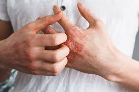 eczema causes treatment and