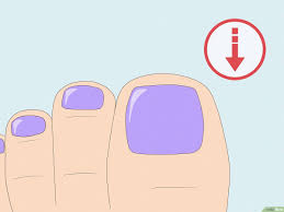 how to fix a split toenail causes
