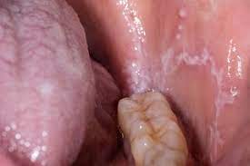 sore or white tongue nhs