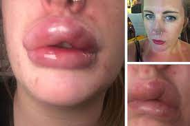 botched lip fillers leave uk mom with