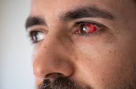 blood vessels to break on the eye