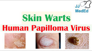 overview of skin warts verrucae