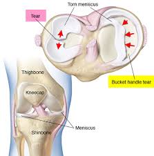 torn meniscus signs symptoms test