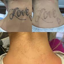 laser tattoo removal specialists in
