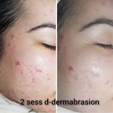 dermabrasion everything you need to