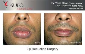 lip reduction surgery in toronto