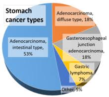 It's not very common in the uk. Stomach Cancer Wikipedia