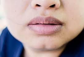 dark lips possible causes treatment