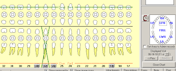 Solved How Do I Perio Chart With A Partial Denture In Cha