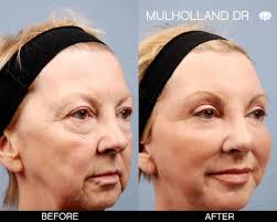 An alternative to the traditional facelift? Toronto Facelift Rhytidectomy Toronto Plastic Surgeons