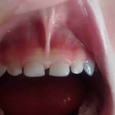 30 tongue tie signs and how to treat