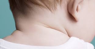 baby yeast infection on the neck