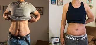 sagging skin after weight loss surgery