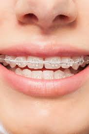 If you need to correct crowded or crooked teeth, traditional braces are one of the most tried and. Orthodontics Maloccclusion Other Problems And Starting Treatment