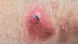 infected ingrown hair pictures