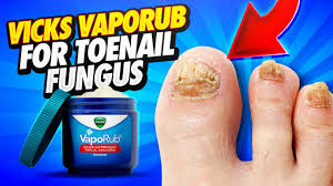 vicks vaporub for nail fungus hot