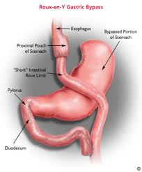 gastric byp weight loss surgery