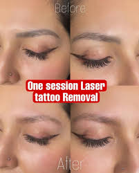 laser tattoo removal dallas tx tattoo