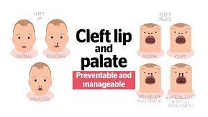cleft lip and palate preventable and