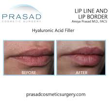 treatment for wrinkles above lips