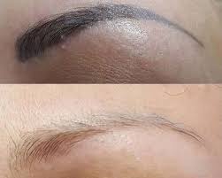 permanent makeup removal