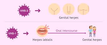 herpes what are the symptoms