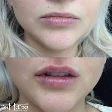 0 5ml and 1ml lip fillers injections