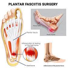 plantar fasciitis specialists in new