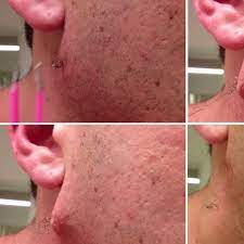 Ingrown hair is a common condition that results from hair removal. Is This The Longest Ingrown Hair In History Man Films Himself Removing Pus Covered Black Strand Mirror Online