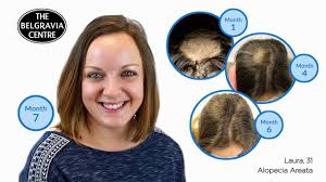 belgravia alopecia areata treatment