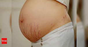 red and white stretch marks